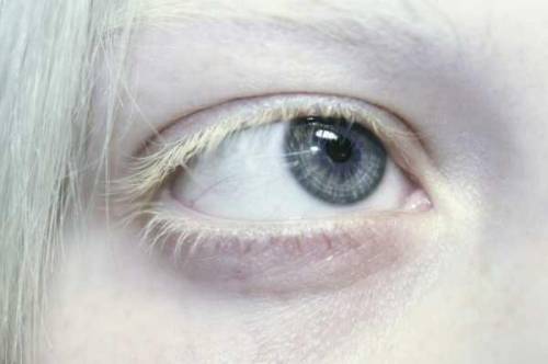 Я нашла фото человека альбиноса с нормальным цветом глаз, но волосы и кожа страдают альбинизмом. Так